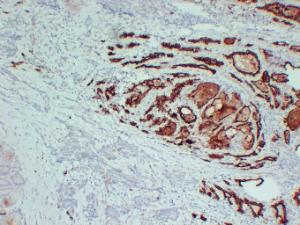 Immunohistochemical analysis of paraffin-embedded human Papillary thyroid carcinoma using Anti-Thyroid Peroxidase Antibody