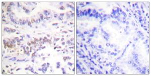 Immunohistochemical analysis of paraffin-embedded human lung carcinoma tissue using Anti-XRCC3 Antibody. The right hand panel represents a negative control, where the antibody was pre-incubated with the immunising peptide