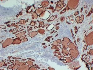 Immunohistochemical analysis of paraffin-embedded human Papillary thyroid carcinoma using Anti-Thyroid Peroxidase Antibody