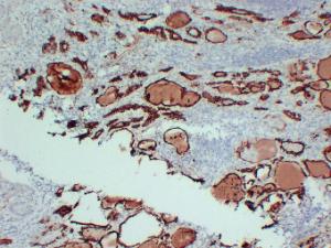 Immunohistochemical analysis of paraffin-embedded human Papillary thyroid carcinoma using Anti-Thyroid Peroxidase Antibody