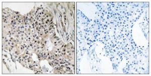 Immunohistochemical analysis of paraffin-embedded human breast carcinoma tissue using Anti-UEVLD Antibody. The right hand panel represents a negative control, where the antibody was pre-incubated with the immunising peptide.