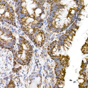 Immunohistochemistry analysis of paraffin-embedded human colon carcinoma tissue using Anti-TOMM20 Antibody [ARC5002-01] (A309191) at a dilution of 1:50(40x lens) Perform microwave antigen retrieval with 10 mM Tris/EDTA buffer pH 90 before commencing with IHC staining protocol