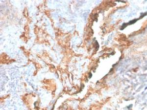 Immunohistochemical analysis of formalin-fixed, paraffin-embedded human lung carcinoma using Anti-Tenascin C Antibody [TNC/2981R]