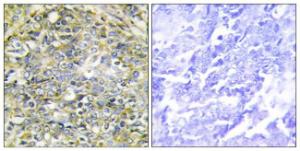 Immunohistochemical analysis of paraffin-embedded human lung carcinoma tissue using Anti-UBXD5 Antibody. The right hand panel represents a negative control, where the Antibody was pre-incubated with the immunising peptide