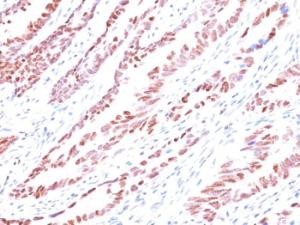 Immunohistochemical analysis of formalin-fixed, paraffin-embedded human colon carcinoma using Anti-p57 Kip2 Antibody [KP10]