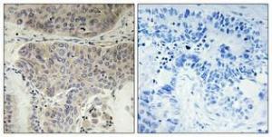 Immunohistochemical analysis of paraffin-embedded human lung cancer using Anti-KIF11 (phospho Thr926) Antibody 1:100 (4°C overnight). The right hand panel represents a negative control, where the antibody was pre-incubated with the immunising peptide.