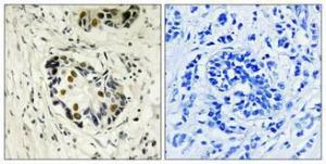 Immunohistochemical analysis of paraffin-embedded human breast cancer using Anti-p53 Antibody 1:100 (4 °C overnight). The right hand panel represents a negative control, where the antibody was pre-incubated with the immunising peptide