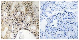 Immunohistochemical analysis of paraffin-embedded human breast carcinoma tissue using Anti-LATS1 + LATS2 Antibody. The right hand panel represents a negative control, where the antibody was pre-incubated with the immunising peptide