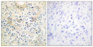 Immunohistochemical analysis of paraffin-embedded human prostate carcinoma tissue using Anti-TM16G Antibody. The right hand panel represents a negative control, where the Antibody was pre-incubated with the immunising peptide