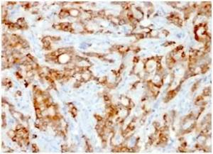 Immunohistochemical analysis of formalin-fixed, paraffin-embedded human lung carcinoma using Anti-beta 2 Microglobulin Antibody [rB2M/961]