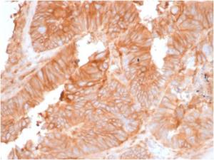 Immunohistochemical analysis of formalin-fixed, paraffin-embedded human colon carcinoma using Anti-beta 2 Microglobulin Antibody [rB2M/961]