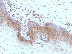 Immunohistochemical analysis of formalin-fixed, paraffin-embedded human cervical carcinoma using Anti-beta 2 Microglobulin Antibody [rB2M/961]