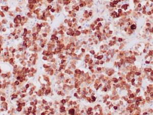 Immunohistochemical analysis of formalin-fixed, paraffin-embedded human pituitary adenoma using Anti-ACTH Antibody [CLIP/1407]