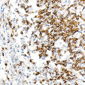 Immunohistochemistry analysis of paraffin-embedded human Hodgkin lymphoma using Anti-IgD Antibody [ARC2240] (A305388) at a dilution of 1:100 (40X lens). Perform high pressure antigen retrieval with 10 mM Tris/EDTA buffer pH 9.0 before commencing with IHC staining protocol