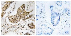 Immunohistochemical analysis of paraffin-embedded human breast carcinoma tissue using Anti-RTCD1 Antibody. The right hand panel represents a negative control, where the antibody was pre-incubated with the immunising peptide