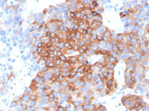 Immunohistochemical analysis of formalin-fixed, paraffin-embedded human bladder carcinoma using Anti-beta III Tubulin Antibody [TUBB3/3732]