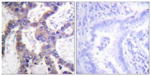 Immunohistochemical analysis of paraffin-embedded human lung carcinoma using Anti-MKP1 (phospho Ser359) Antibody. The right hand panel represents a negative control, where the antibody was pre-incubated with the immunising peptide.