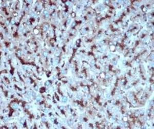 Immunohistochemical analysis of formalin-fixed, paraffin-embedded human liver carcinoma in colon tissue using Anti-Cathepsin D Antibody [CTSD/4497]