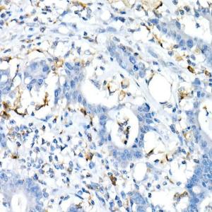 Immunohistochemistry analysis of paraffin-embedded human colon carcinoma tissue using Anti-CD74 Antibody (A9737) at a dilution of 1:20 (40x lens) Perform high pressure antigen retrieval with 10 mM Tris/EDTA buffer pH 90 before commencing with IHC staining protocol