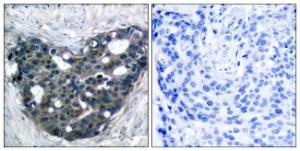 Immunohistochemical analysis of paraffin-embedded human breast carcinoma tissue using Anti-p56 Dok-2 Antibody. The right hand panel represents a negative control, where the antibody was pre-incubated with the immunising peptide.