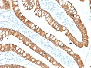 Immunohistochemical analysis of formalin-fixed, paraffin-embedded human colon carcinoma using Anti-Cytokeratin 20 Antibody [SPM140]