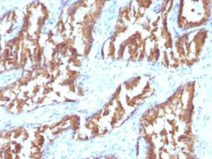 Immunohistochemical analysis of formalin-fixed, paraffin-embedded human prostate carcinoma using Anti-IDH1 Antibody [IDH1/1152]