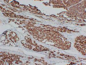 Immunohistochemical analysis of paraffin-embedded human Parathyroidoma using Anti-Parathyroid Hormone Antibody