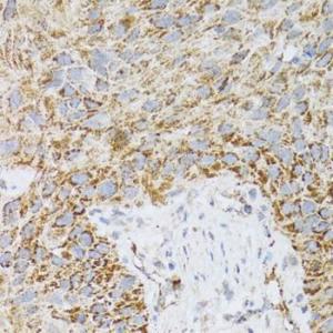 Immunohistochemistry analysis of paraffin-embedded human lung cancer using Anti-ProDynorphin Antibody (A9754) at a dilution of 1:100 (40x lens). Perform microwave antigen retrieval with 10 mM PBS buffer pH 7.2 before commencing with IHC staining protocol