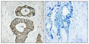 Immunohistochemical analysis of paraffin-embedded human colon cancer using Anti-Met Antibody 1:100 (4°C overnight). The right hand panel represents a negative control, where the antibody was pre-incubated with the immunising peptide.