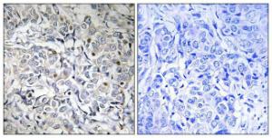 Immunohistochemical analysis of paraffin-embedded human breast carcinoma using Anti-NF-kappaB p65 (phospho Thr505) Antibody. The right hand panel represents a negative control, where the antibody was pre-incubated with the immunising peptide