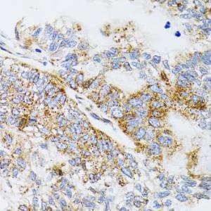 Immunohistochemistry analysis of paraffin-embedded human gastric cancer using Anti-ProDynorphin Antibody (A9754) at a dilution of 1:100 (40x lens). Perform microwave antigen retrieval with 10 mM PBS buffer pH 7.2 before commencing with IHC staining protocol