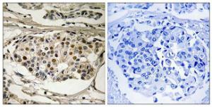 Immunohistochemical analysis of paraffin-embedded human breast carcinoma using Anti-NF-kappaB p65 (phospho Ser281) Antibody. The right hand panel represents a negative control, where the antibody was pre-incubated with the immunising peptide.