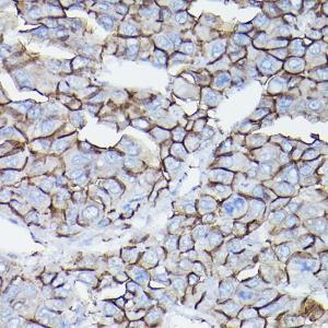 Immunohistochemistry analysis of paraffin-embedded human liver cancer using Anti-delta 1 Catenin / CAS Antibody (A306307) at a dilution of 1:50 (40x lens). Perform high pressure antigen retrieval with 10 mM citrate buffer pH 6.0 before commencing with IHC staining protocol.