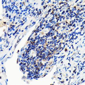 Immunohistochemistry analysis of paraffin-embedded human lung cancer using Anti-GRB2 Antibody [ARC0430] (A309206) at a dilution of 1:100 (40x lens). Perform microwave antigen retrieval with 10 mM PBS buffer pH 7.2 before commencing with IHC staining protocol