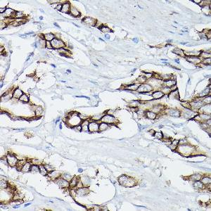 Immunohistochemistry analysis of paraffin-embedded human prostate cancer using Anti-delta 1 Catenin / CAS Antibody (A306307) at a dilution of 1:50 (40x lens). Perform high pressure antigen retrieval with 10 mM citrate buffer pH 6.0 before commencing with IHC staining protocol.