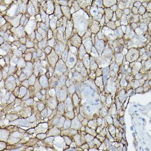 Immunohistochemistry analysis of paraffin-embedded human urothelial carcinoma using Anti-delta 1 Catenin / CAS Antibody (A306307) at a dilution of 1:50 (40x lens). Perform high pressure antigen retrieval with 10 mM citrate buffer pH 6.0 before commencing with IHC staining protocol.