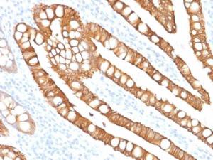 Immunohistochemical analysis of formalin-fixed, paraffin-embedded human colon carcinoma using Anti-Cytokeratin 20 Antibody [SPM191]