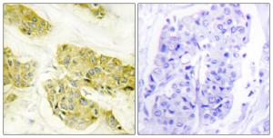 Immunohistochemical analysis of paraffin-embedded human breast carcinoma tissue using Anti-Collagen V alpha3 Antibody. The right hand panel represents a negative control, where the Antibody was pre-incubated with the immunising peptide