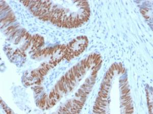 Immunohistochemical analysis of formalin-fixed, paraffin-embedded human colon carcinoma using Anti-CDX2 Antibody [CDX2/2951R]