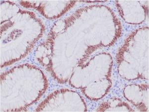 Immunohistochemical analysis of formalin-fixed, paraffin-embedded human colon adenocarcinoma using Anti-CDX2 Antibody [CDX2/4394R]