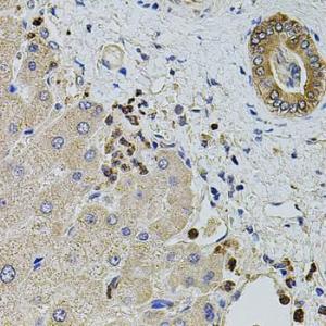 Immunohistochemistry of paraffin-embedded human liver injury using Anti-KTN1 Antibody (A5879) at dilution of 1:100 (40x lens)