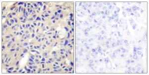 Immunohistochemical analysis of paraffin-embedded human breast carcinoma tissue using Anti-Collagen V alpha2 Antibody. The right hand panel represents a negative control, where the antibody was pre-incubated with the immunising peptide