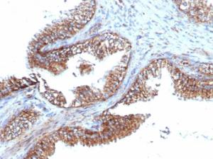 Immunohistochemical analysis of formalin-fixed, paraffin-embedded human prostate carcinoma using Anti-PMEPA1 Antibody [PMEPA1/6421R]