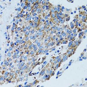 Immunohistochemistry analysis of paraffin-embedded human lung cancer using Anti-MRPL28 Antibody (A9764) at a dilution of 1:100 (40x lens). Perform microwave antigen retrieval with 10 mM PBS buffer pH 7.2 before commencing with IHC staining protocol