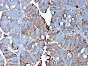 Immunohistochemical analysis of formalin-fixed, paraffin-embedded human colon carcinoma using Anti-MerTK Antibody [MERTK/3015]