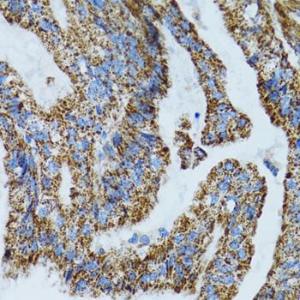 Immunohistochemistry analysis of paraffin-embedded human gastric cancer using Anti-MRPL28 Antibody (A9764) at a dilution of 1:100 (40x lens). Perform microwave antigen retrieval with 10 mM PBS buffer pH 7.2 before commencing with IHC staining protocol