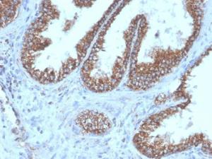 Immunohistochemical analysis of formalin-fixed, paraffin-embedded human prostate carcinoma using Anti-PMEPA1 Antibody [PMEPA1/6421R]