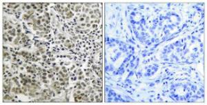 Immunohistochemical analysis of paraffin-embedded human prostate carcinoma tissue using Anti-Androgen Receptor Antibody The right hand panel represents a negative control, where the antibody was pre-incubated with the immunising peptide