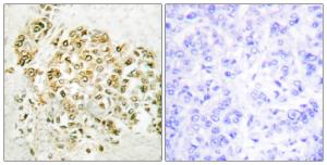 Immunohistochemical analysis of paraffin-embedded human breast carcinoma tissue using Anti-MZF-1 Antibody The right hand panel represents a negative control, where the antibody was pre-incubated with the immunising peptide