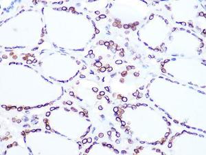 Immunohistochemistry analysis of paraffin-embedded human thyroid cancer using Anti-Lamin B2 Antibody [ARC1252] (A309214) at a dilution of 1:100 (40x lens)